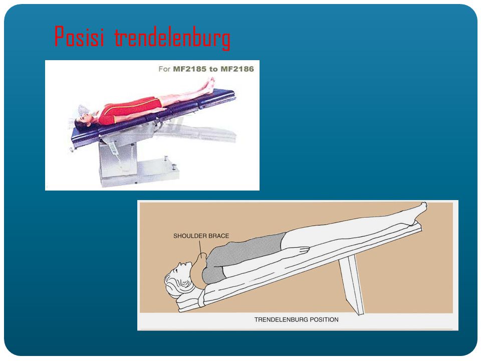 Trendelenburg para que sirve